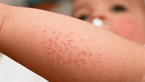 Những điều cần đặc biệt lưu ý về sốt xuất huyết ở trẻ
