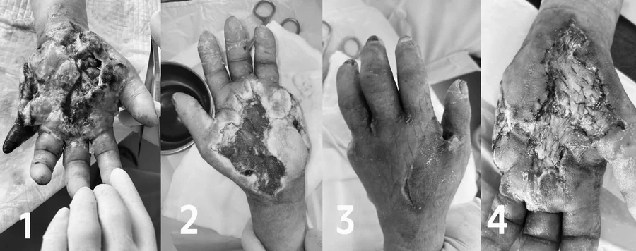 Trên nền bệnh tiểu đường, tình trạng nhiễm trùng của chị Y. lan rộng nhanh chóng. Ảnh: BVCC