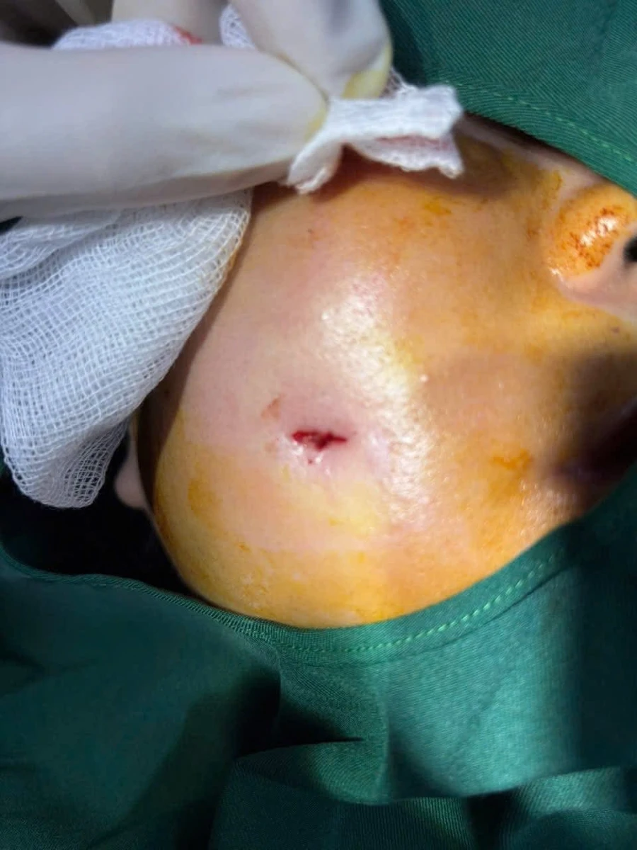 Bệnh nhân có lỗ rò chảy mủ ở niêm mạc má tại vị trí thắt đồng tiền sau thực hiện tạo hình. Ảnh: BVCC