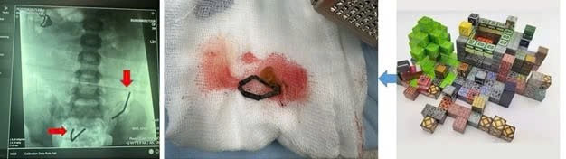 Nuốt 20 viên nam châm đồ chơi Lego, bé trai 5 tuổi thủng 8 lỗ ruột non- Ảnh 1.