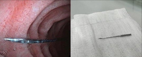 Hình ảnh dị vật trước và sau khi được các bác sĩ lấy ra.